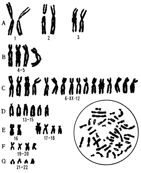 Нормальный хромосомный набор человека (женщины). Хромосомы рассортированы и пронумерованы в соответствии с денверской классификацией (определенными правилами сортировки и нумерации хромосом). Справа внизу (в кружке) соответствующая этому набору метафазная пластинка с беспорядочным расположением хромосом