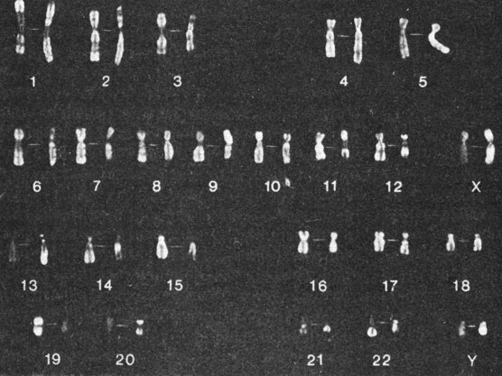 Рис. 2.9. Кариотип мужчины. Хромосомы окрашены Q - (справа) и R - (слева) методами. (Courtesy of T. M. Schroeder-Kurth.)
