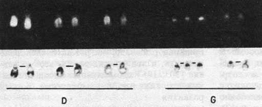Рис. 2.30. D- и G-хромосомы больного с синдромом Дауна. Окрашивание Q- и G-методом. Обратите внимание на широкий сегмент в проксимальном районе 21p, по которому хромосома 21 отличается от хромосомы 22. (Courtesy of Dr.T.M. Schroeder-Kurth.)