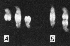Рис. 2.31. А. Тандемная дупликация в одной из хромосом 21-й пары, не захватывающая сегмент 21 q 22 (средняя хромосома), у ребенка с неглубокой умственной отсталостью и с отсутствием многих признаков синдрома Дауна [371]. Б. Аномальная хромосома (слева) и для сравнения две нормальные хромосомы 21, совмещенные на фотографии теломерами (справа). Здесь в отличие от хромосомы с дупликацией полоса 21 q 22 выглядит удвоенной