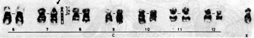 Рис. 2.38. Перицентрическая инверсия хромосомы 7 у здорового мужчины, G-окрашивание. Инвертированный сегмент изображен схематически (INV). Другие хромосомы показаны для сравнения. (Courtesy of Dr.T.M. Schroeder-Kurth.)