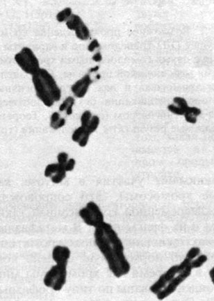 Рис. 2.45. Преждевременная конденсация хромосом: профазоподобные хромосомы из микроядер вместе с некоторыми другими, нормальными метафазными хромосомами. (Courtesy of Dr.T.M. Schroeder-Kurth.)