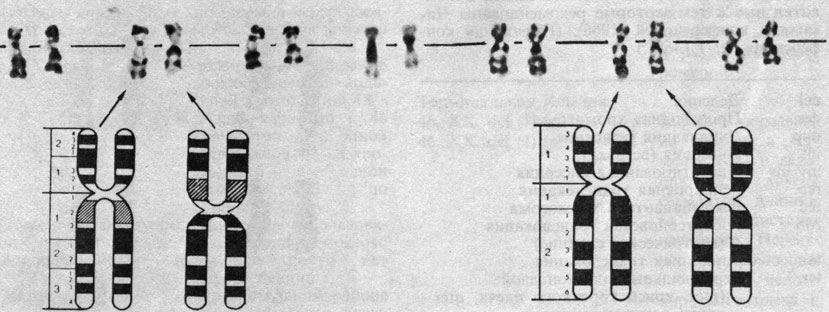 Рис. 2.49. Хромосома 9 от разных гетерозигот по одинаковой инверсии inv 9 (pl; q13). В каждой паре слева помещен нормальный гомолог, справа - инвертированная хромосома, три препарата окрашены по G-методу, один - по C-методу. Две правые пары хромосом принадлежат индивиду со вторичной перетяжкой в нормальном гомологе. Рис. 2.50. Хромосома 10 от разных индивидов, гетерозиготных по одинаковой инверсии inv (pl; q21). В каждой паре нормальный гомолог помещен слева, а инвертированная хромосома - справа. Препараты окрашены G-методом
