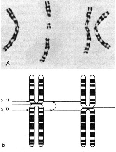 Рис. 2.51. Перицентрическая инверсия в хромосоме 2. А. G-окрашивание. Б. Схематическое изображение сегментации [419]