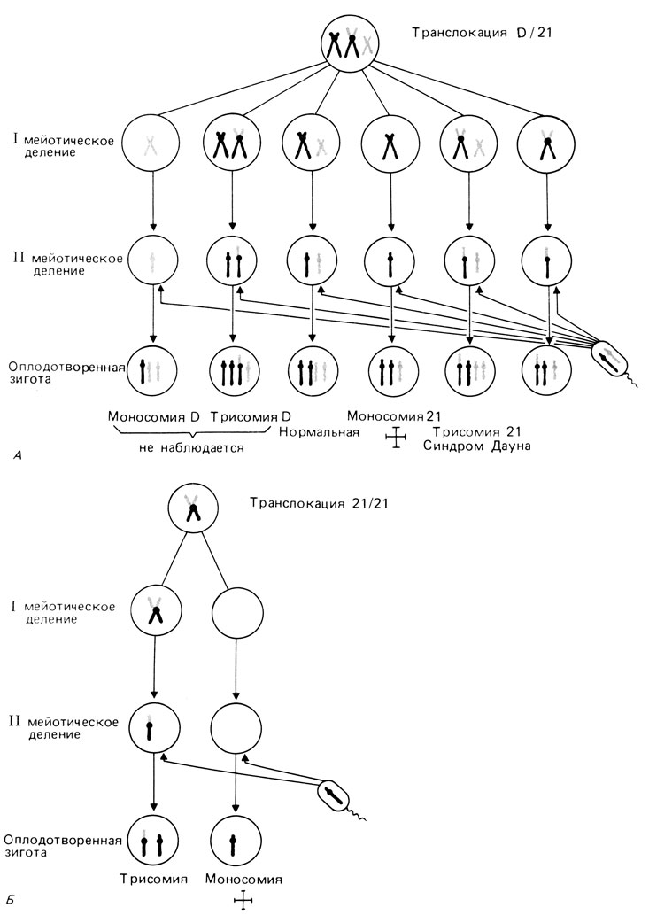Рис. 2.58. А. Схема образования половых клеток у женщины - носительницы сбалансированной транслокации D/21: одна D-хромосома приобретает транслоцированное длинное плечо хромосомы 21. В результате остается только одна свободная хромосома 21. Поскольку эта свободная хромосома 21 и две D-хромосомы комбинируются случайно, теоретически может образоваться шесть разных типов гамет и после оплодотворения нормальным сперматозоидом соответственно шесть разных типов зигот. Однако три типа из шести возможных не обнаруживаются. Остальные индивиды либо нормальны, либо имеют сбалансированный кариотип, либо трисомики. Б. Образование половых клеток с транслокацией 21/21 и 21-изохромосомой. Существует две возможности: если транслоцированная хромосома попадет в половую клетку, то зигота окажется функционально трисомной и у ребенка будет синдром Дауна; в том случае, если транслокационная хромосома не попадет в половую клетку, зигота будет лишена хромосомы 21 и погибнет