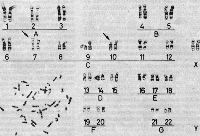 Рис. 2.63. Кариотип матери двух детей, показанных на рис. 2.61, с реципрокной транслокацией, в которой участвуют хромосомы 7 и 10. Эти две хромосомы указаны стрелками (G-окрашивание) [504]